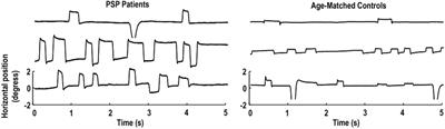 Microsaccade Characteristics in Neurological and Ophthalmic Disease